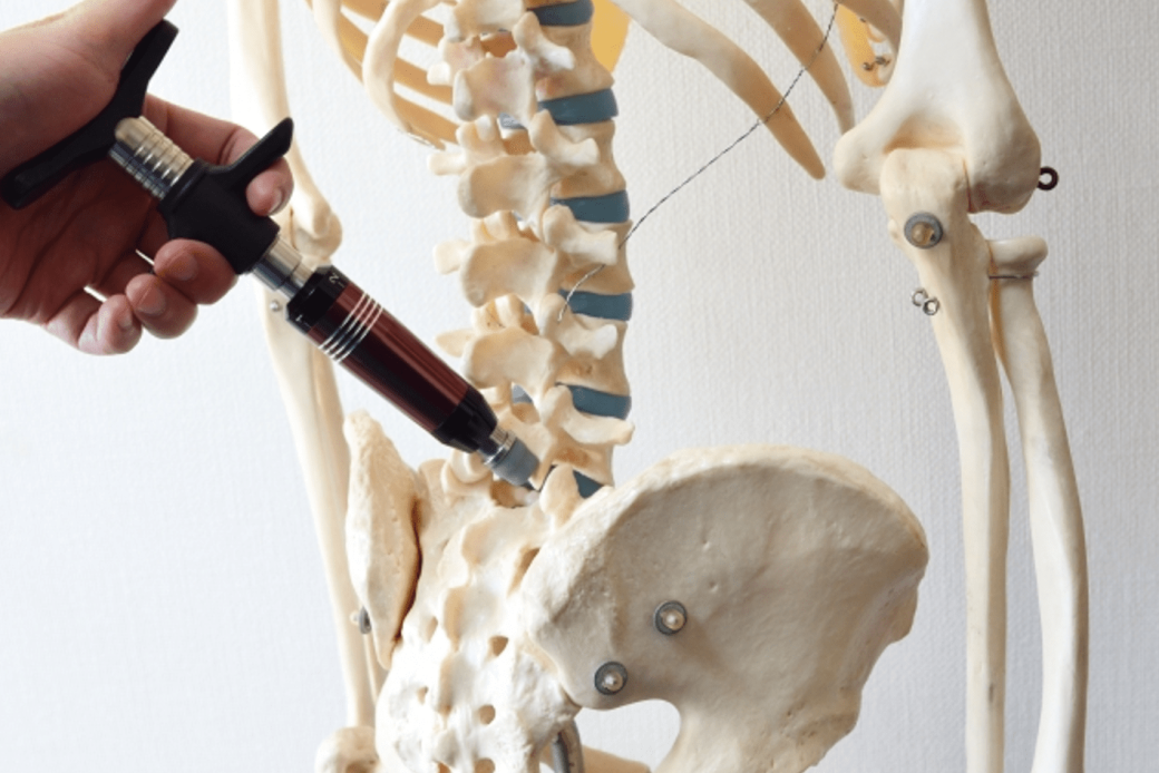 脊柱側弯症を改善する専用リハビリ「側弯トレーニング」とは？